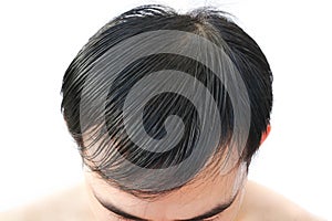 Young man serious hair loss problem for health care shampoo and