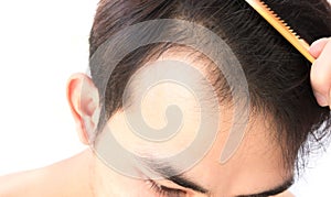 Young man serious hair loss problem for health care shampoo and