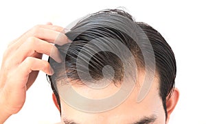 Young man serious hair loss problem for health care shampoo and