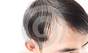 Young man serious hair loss problem for health care shampoo and