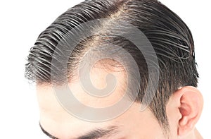 Young man serious hair loss problem for health care shampoo and