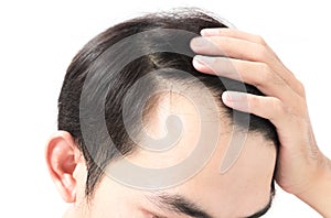 Young man serious hair loss problem for health care shampoo and