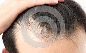 Young man serious hair loss problem for health care shampoo and