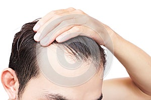 Young man serious hair loss problem for health care shampoo and