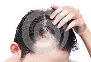 Young man serious hair loss problem for health care shampoo and