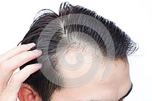 Young man serious hair loss problem for health care shampoo and