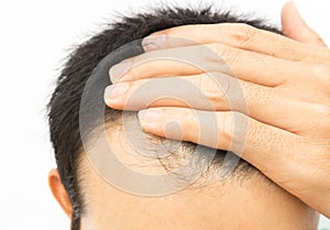 Young man serious hair loss problem on white background