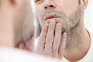 Young man suffering from herpes on his mouth