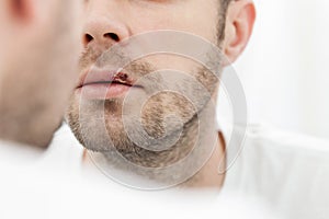 Young man suffering from herpes on his mouth