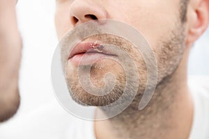 Young man suffering from herpes on his mouth