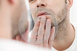 Young man suffering from herpes on his mouth photo