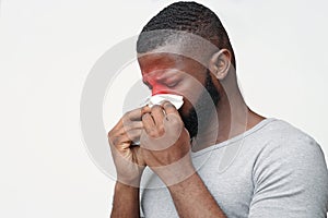 Young man suffering from sinusitis, touching nose with napkin