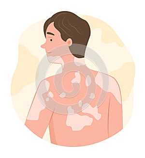 Young Man with Vitiligo Disease on Body Skin for Dermatological Symptom Concept Illustration Clip Art photo