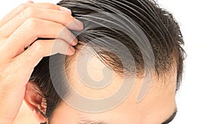 Young man worry hair loss problem for health care shampoo and be