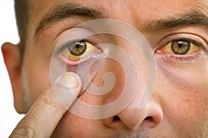 Young man with yellowish eyes and skin. Jaundice, liver disease photo