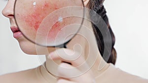 Young pretty woman shows redness on her cheek through a magnifying glass. Close up. The concept of rosacea and skin