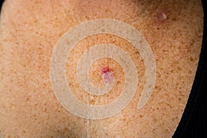 Young 30s caucasian female is anxious aftern superficial basal cell carcinoma skin cancer diagnosis photo