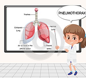 Young scientist explain pneumothorax in front of a board in laboratory