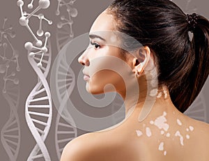 Young sensual woman with vitiligo in DNA chains.