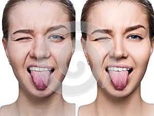 Young woman with acne before and after retouch.