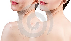 Young woman with acne on shoulders before and after treatment.