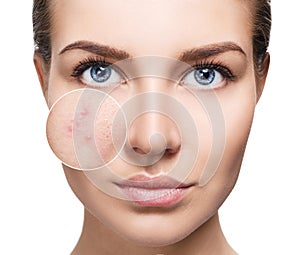 Young woman with acne skin in zoom circle.