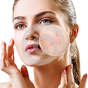 Young woman with acne skin in zoom circle.