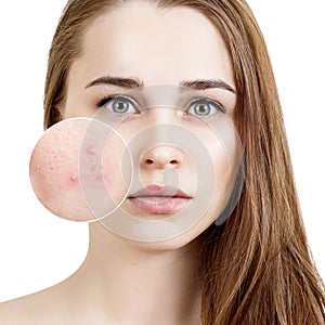 Young woman with acne skin in zoom circle.