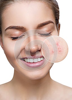 Young woman with acne skin in zoom circle.