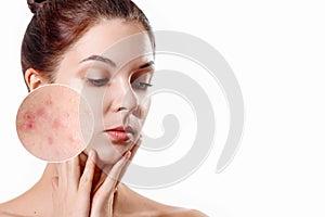 Young woman with acne skin in zoom circle. Skin care concept. Young girl, beauty portrait. Close-up
