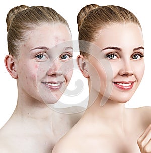 Young woman with acne before and after treatment.