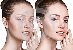 Young woman with acne before and after treatment