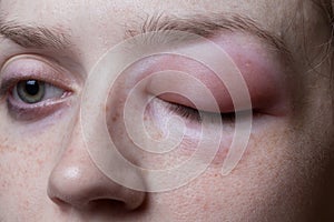 Young woman with allergic reaction