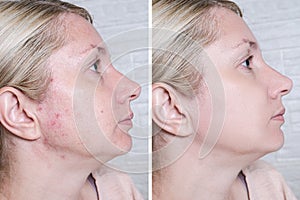 Young woman before and after anti acne treatment, skincare and dermatology concept