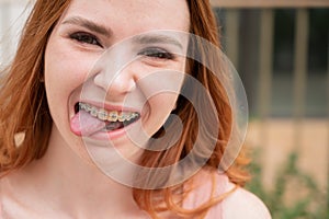 Young woman with braces on her teeth smiles and shows her tongue outdoors.