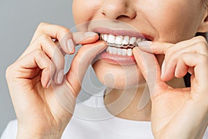 A young woman does a home teeth whitening procedure. Whitening tray with gel