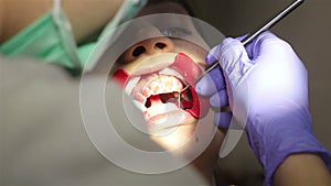 Young woman with an expander in mouth at the dental clinic. Application of protective whitening gel to the teeth.