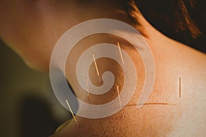 Young woman getting acupuncture treatment