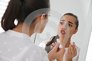 Young woman with herpes applying lip balm in front of mirror at home