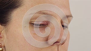 Young woman with hordeolum disease in the eye.