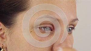 Young woman with hordeolum disease in the eye.