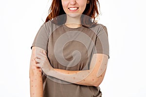 A young woman is nervously scratching her hands for rashes and redness. White background. Close up. The concept of scabies and