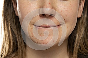 Young woman with the pimples on her face. Problematic skin