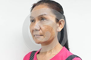 Young woman Problem skin face blemish on white background