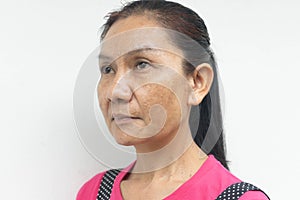 Young woman Problem skin face blemish on white background photo