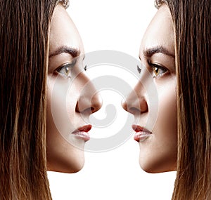 Young woman in profile before and after rhinoplasty. photo
