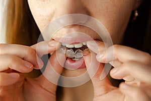 Young woman puts transparent aligner for dental treatment