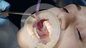 Young woman with a retractor in her mouth in a dental clinic. Brushing teeth with water. Dentist using saliva ejector or