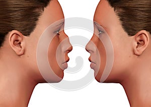 Young woman before and after rhinoplasty on white background. Plastic surgery
