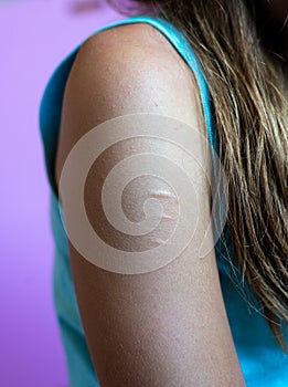 Young woman's  arm showing scars from self mutilation ,on plain background self harm . room for text